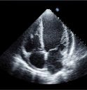 Pedemontana, arriva un nuovo ecocardiografo