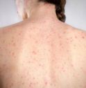 Morbillo, l'allarme dell'infettivologo Andreoni: 