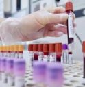 Sclerosi multipla recidivante, Ema raccomanda approvazione ocrelizumab dai 10 anni.