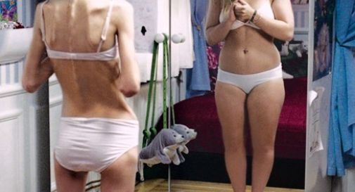 Un giovane su dieci soffre di anoressia