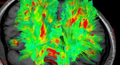 Cervello, così può ammalarsi per stress