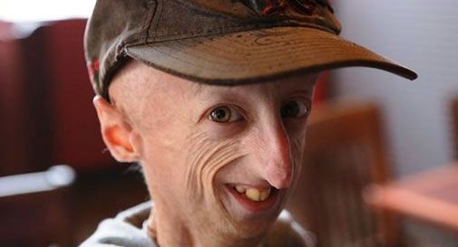 Sammy Basso e i lavoratori del Porto di Venezia uniti nella lotta alla progeria