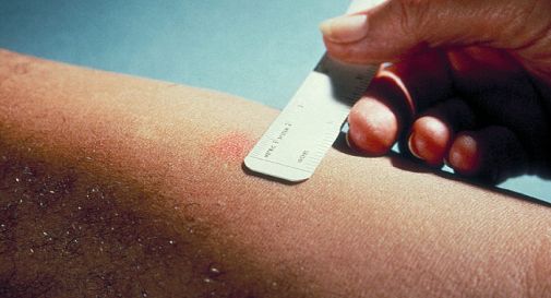 Tubercolosi al nido, necessario il trattamento preventivo 