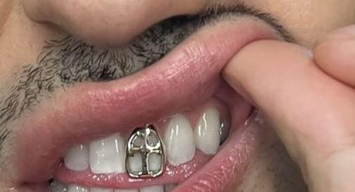 Gioielli sui denti, è grillz mania: possibili rischi.