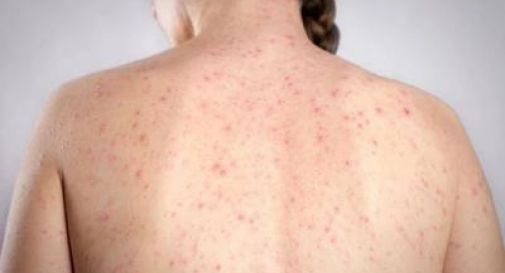 Morbillo, l'allarme dell'infettivologo Andreoni: 