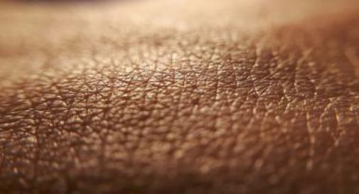 Dermatite atopica, quando la pelle condiziona la vita, 'Diari atipici' dà voce ai pazienti.